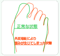 外反母趾のイラスト